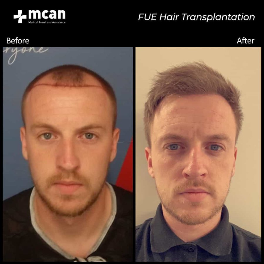 MCAN Health Hair Transplant - Kadikoy - MCAN Health Hair Transplant - Kadikoy