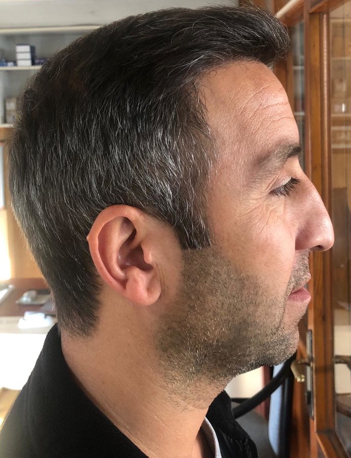 Medicalhair Turkey - Dr. Sibel Ulusan - Medicalhair Turkey - Dr. Sibel Ulusan