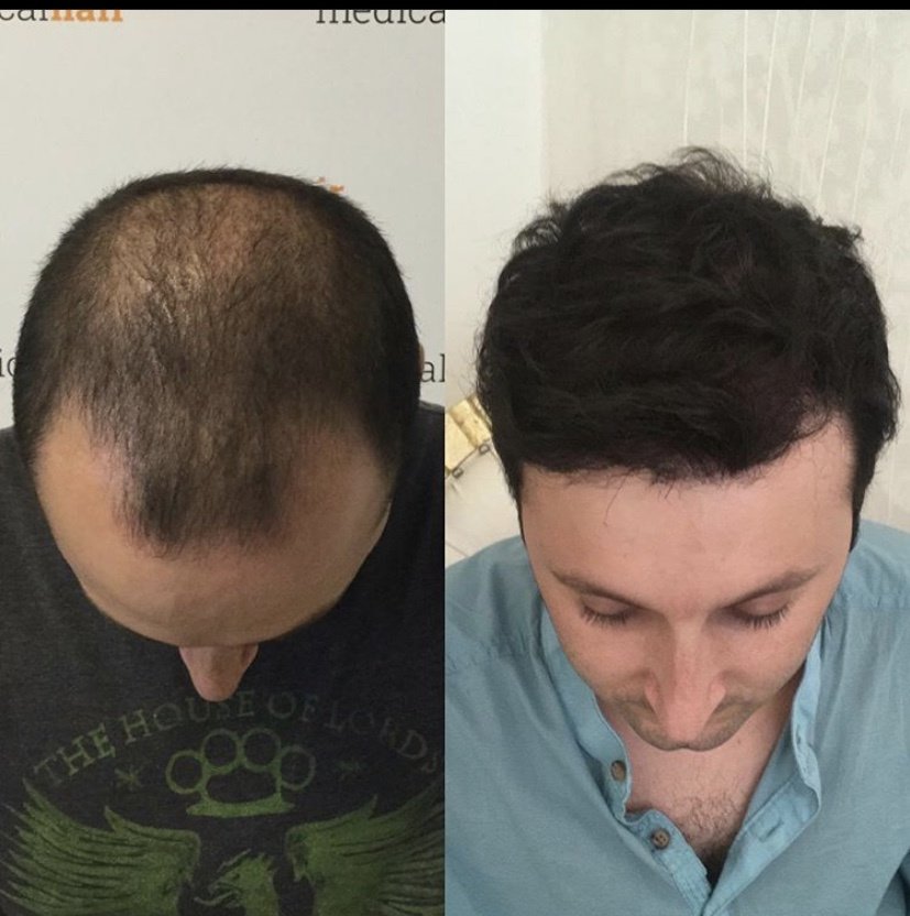 Medicalhair Turkey - Dr. Sibel Ulusan - Medicalhair Turkey - Dr. Sibel Ulusan