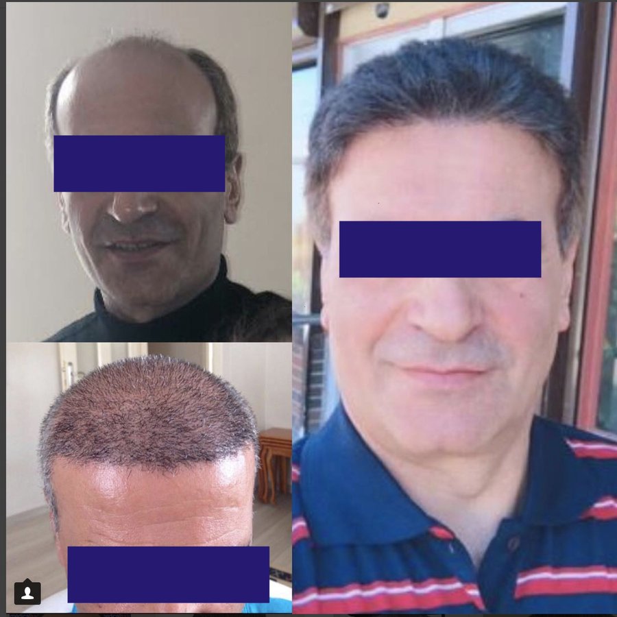 Medicalhair Turkey - Dr. Sibel Ulusan - Medicalhair Turkey - Dr. Sibel Ulusan