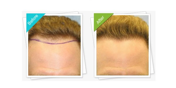 MediHair Hair Transplant Melbourne - MediHair Hair Transplant Melbourne