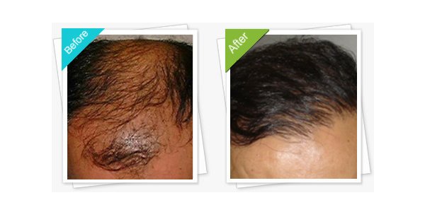 MediHair Hair Transplant Melbourne - MediHair Hair Transplant Melbourne