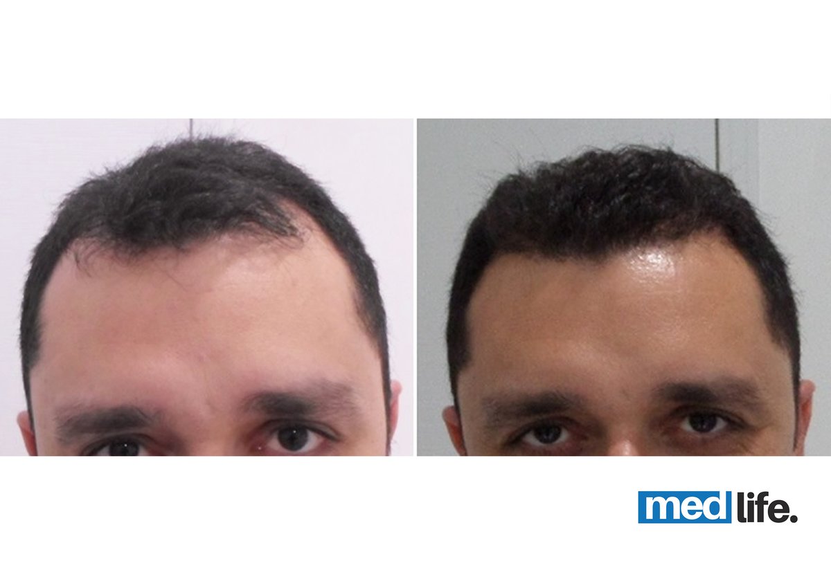 Medlife Group - Hair Transplant - Kusadasi - Medlife Group - Hair Transplant - Kusadasi