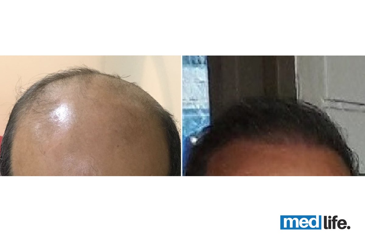 Medlife Group - Hair Transplant - Kusadasi - Medlife Group - Hair Transplant - Kusadasi