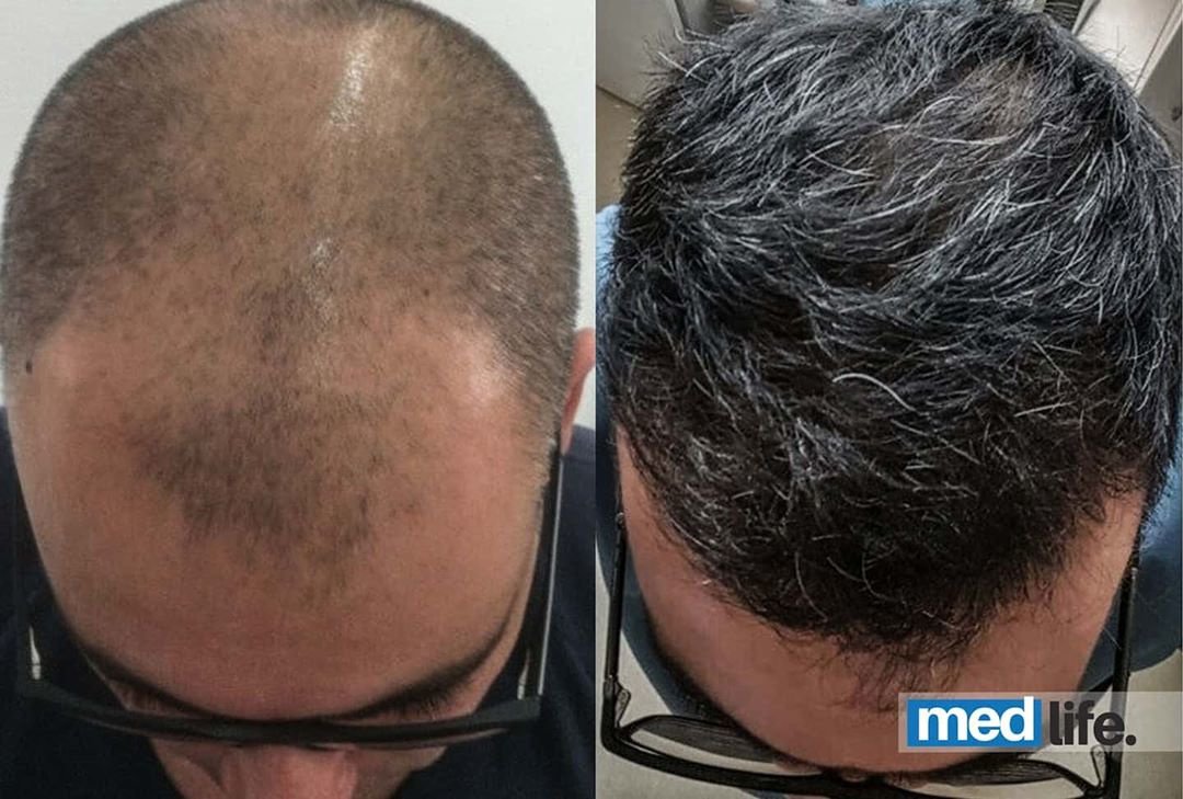Medlife Group - Hair Transplant - Kusadasi - Medlife Group - Hair Transplant - Kusadasi