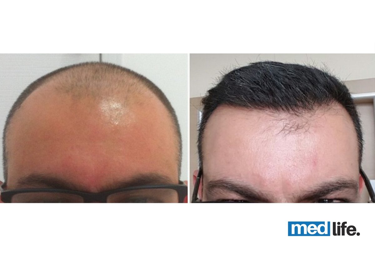 Medlife Group - Hair Transplant - Kusadasi - Medlife Group - Hair Transplant - Kusadasi
