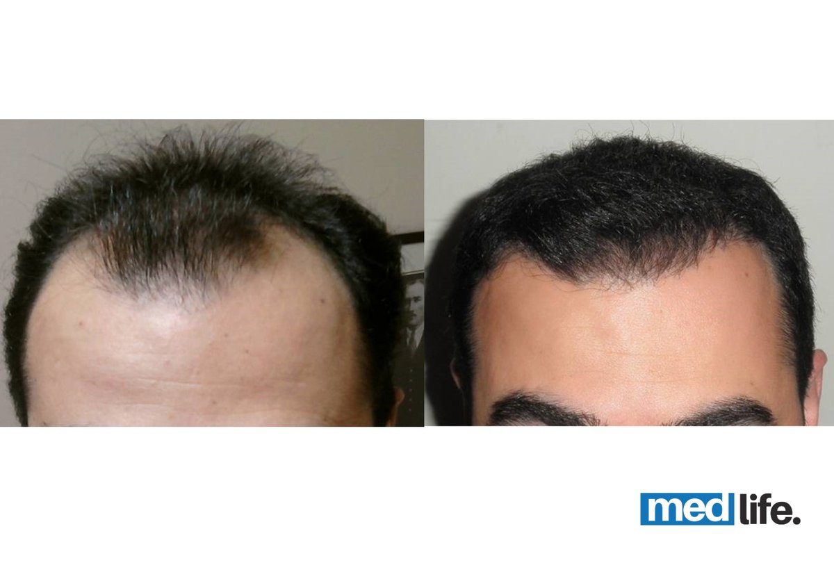 Medlife Group - Hair Transplant - Kusadasi - Medlife Group - Hair Transplant - Kusadasi