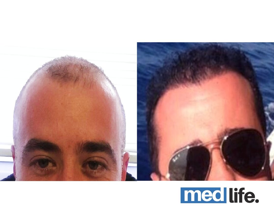 Medlife Group - Hair Transplant - Kusadasi - Medlife Group - Hair Transplant - Kusadasi