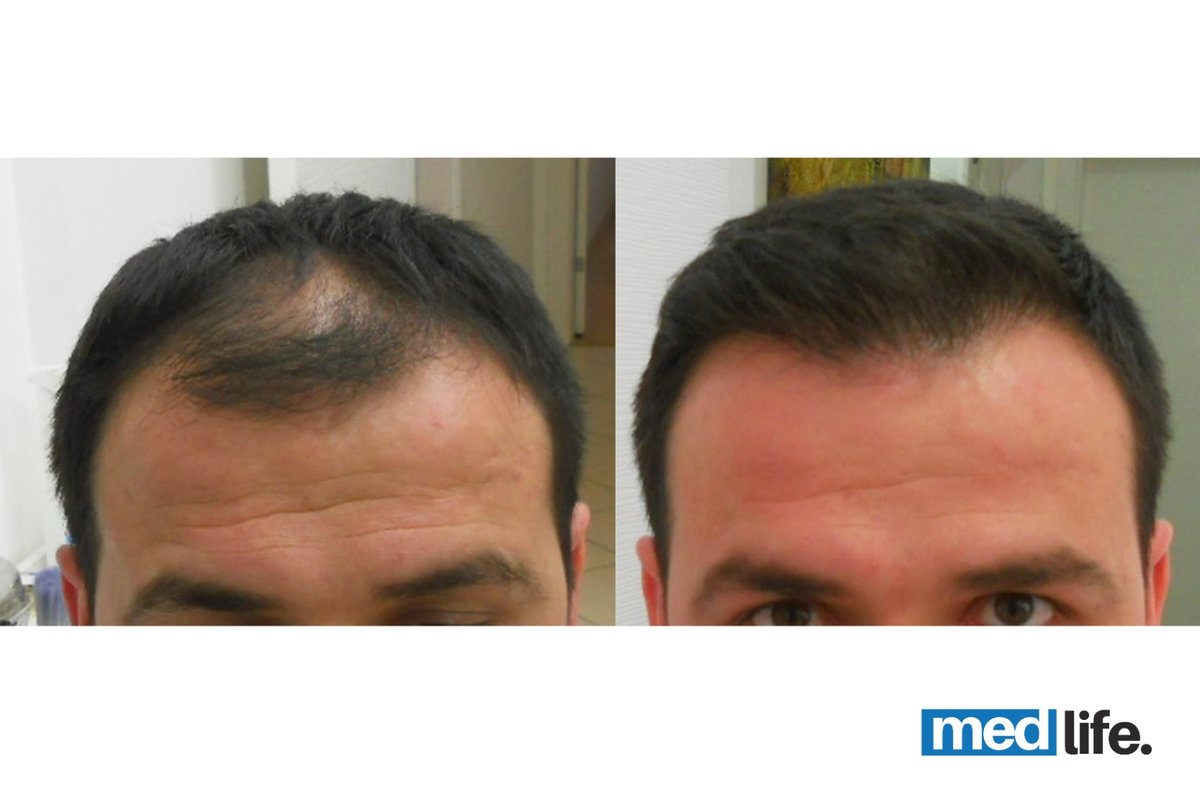 Medlife Group - Hair Transplant - Kusadasi - Medlife Group - Hair Transplant - Kusadasi