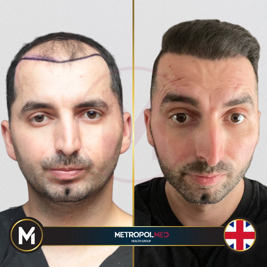 Metropol Med Hair Transplant - Metropol Med Hair Transplant