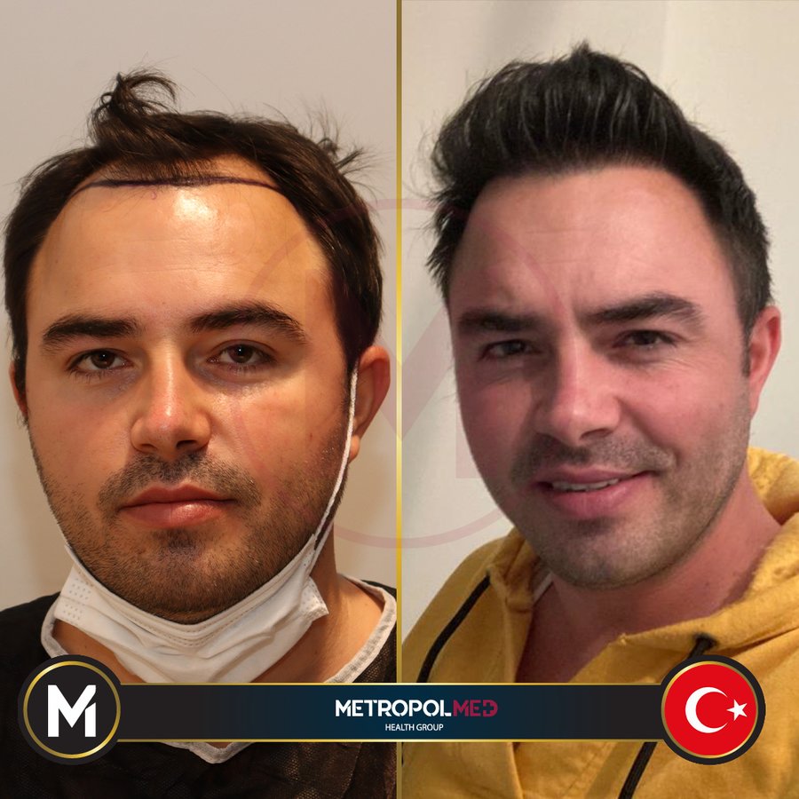 Metropol Med Hair Transplant - Metropol Med Hair Transplant