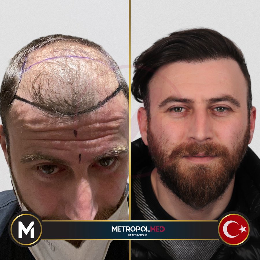 Metropol Med Hair Transplant - Metropol Med Hair Transplant