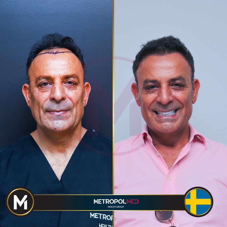 Metropol Med Hair Transplant - Metropol Med Hair Transplant