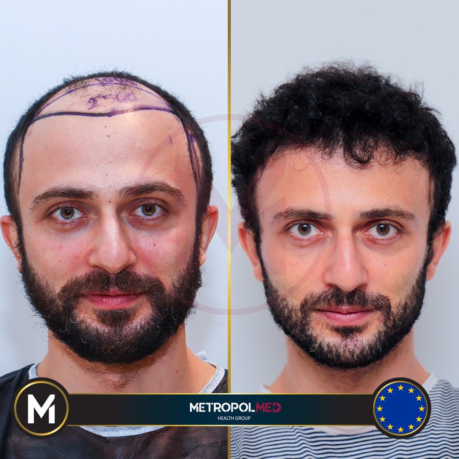 Metropol Med Hair Transplant - Metropol Med Hair Transplant
