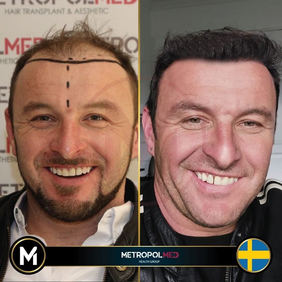 Metropol Med Hair Transplant - Metropol Med Hair Transplant