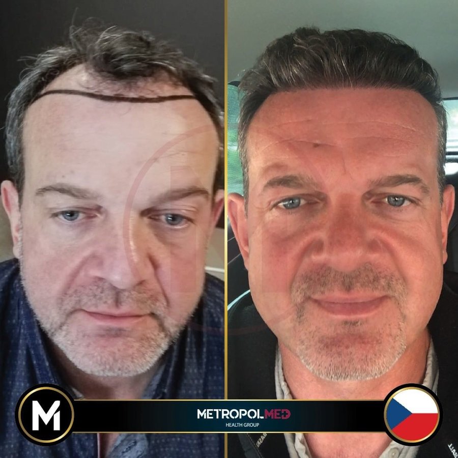 Metropol Med Hair Transplant - Metropol Med Hair Transplant
