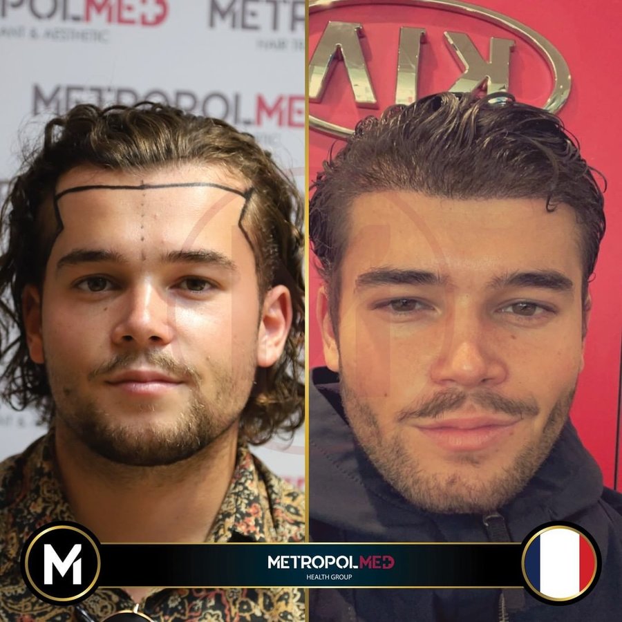 Metropol Med Hair Transplant - Metropol Med Hair Transplant