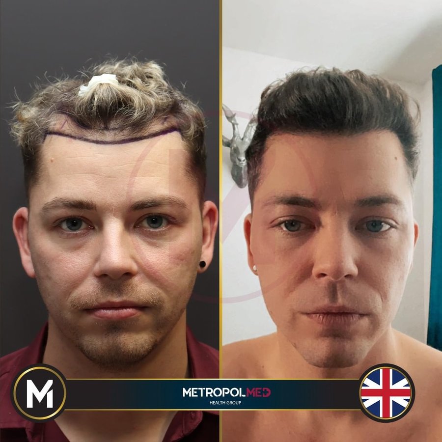 Metropol Med Hair Transplant - Metropol Med Hair Transplant
