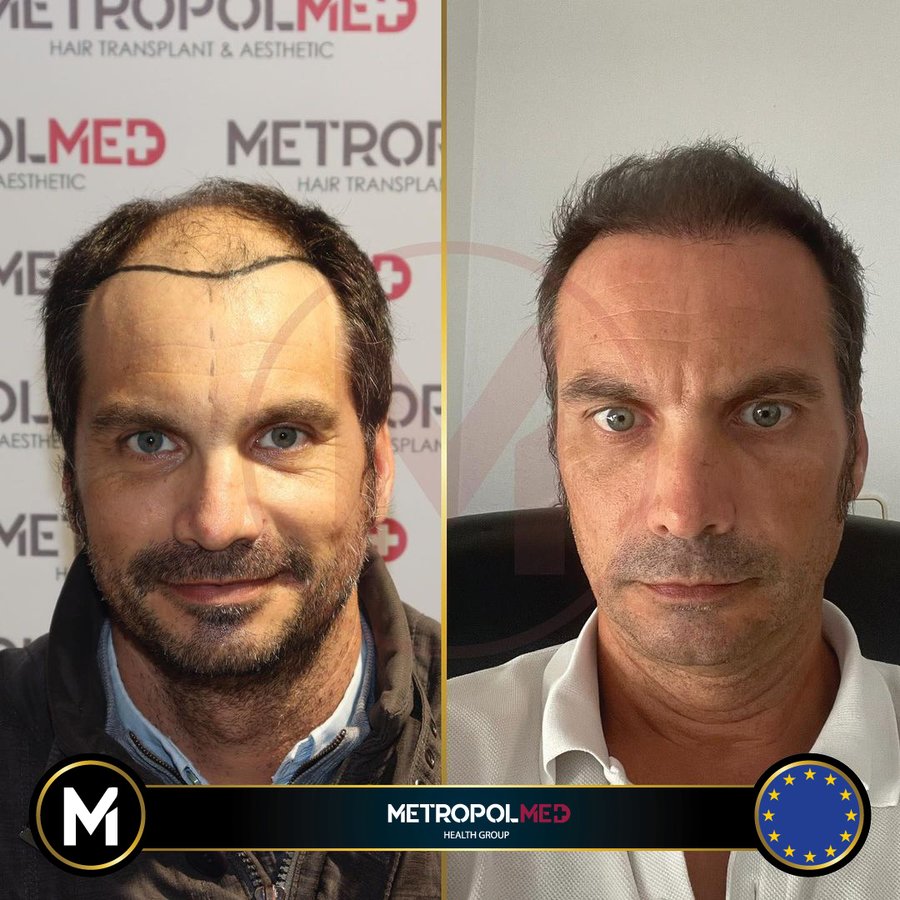 Metropol Med Hair Transplant - Metropol Med Hair Transplant