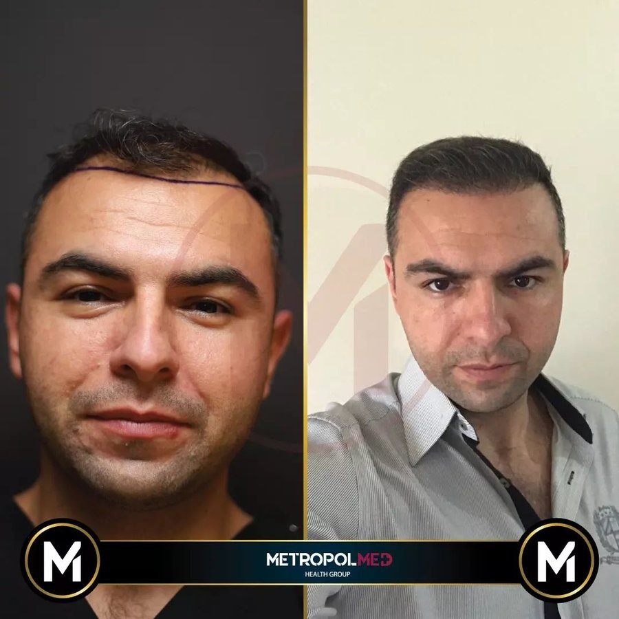 Metropol Med Hair Transplant - Metropol Med Hair Transplant