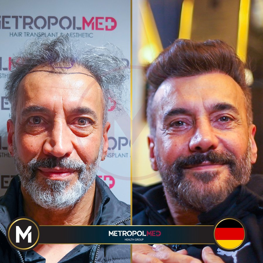 Metropol Med Hair Transplant - Metropol Med Hair Transplant
