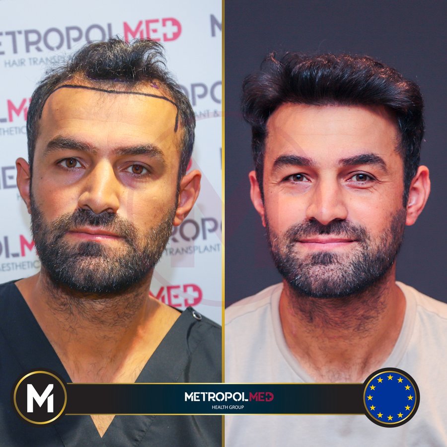 Metropol Med Hair Transplant - Metropol Med Hair Transplant