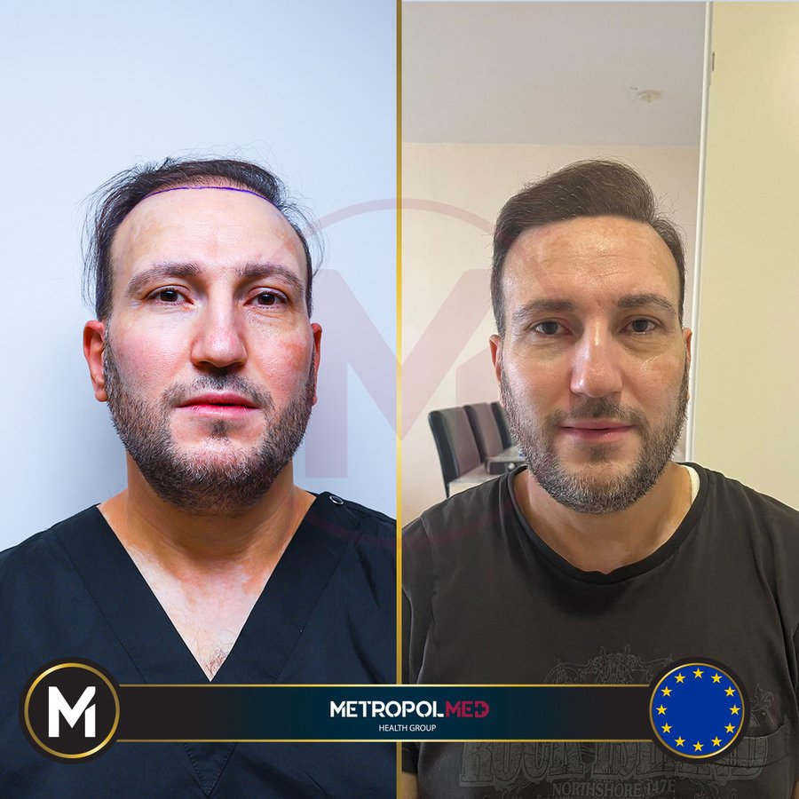 Metropol Med Hair Transplant - Metropol Med Hair Transplant