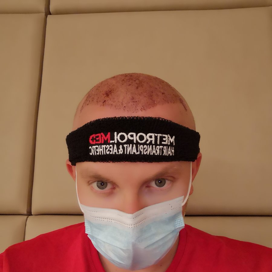 Metropol Med Hair Transplant - Metropol Med Hair Transplant