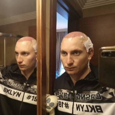 Metropol Med Hair Transplant - Metropol Med Hair Transplant