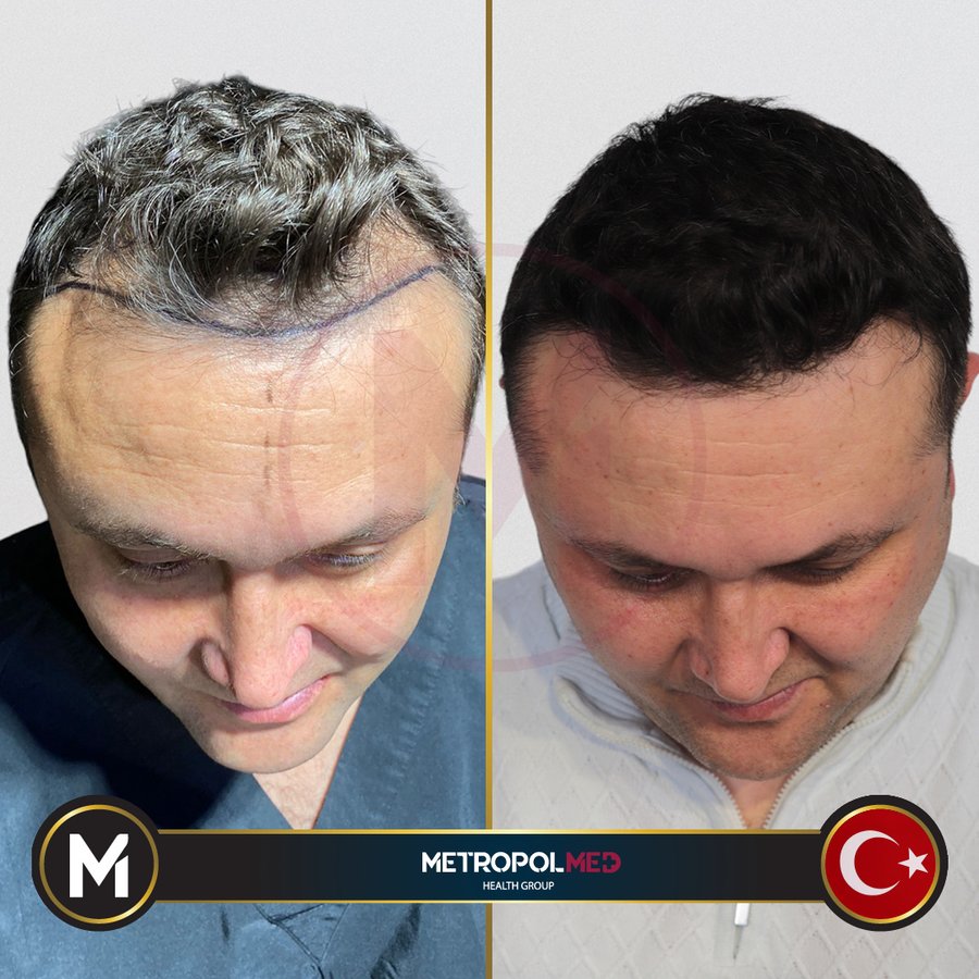 Metropol Med Hair Transplant - Metropol Med Hair Transplant