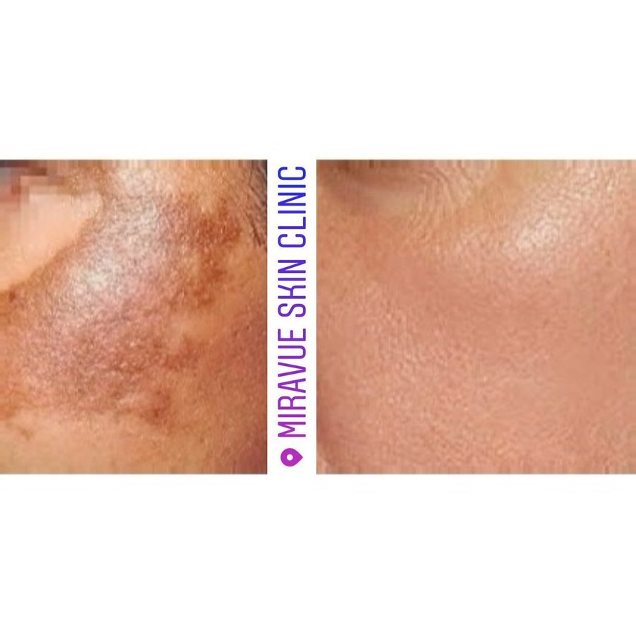 Miravue Skin Clinic - Ealing - Miravue Skin Clinic - Ealing