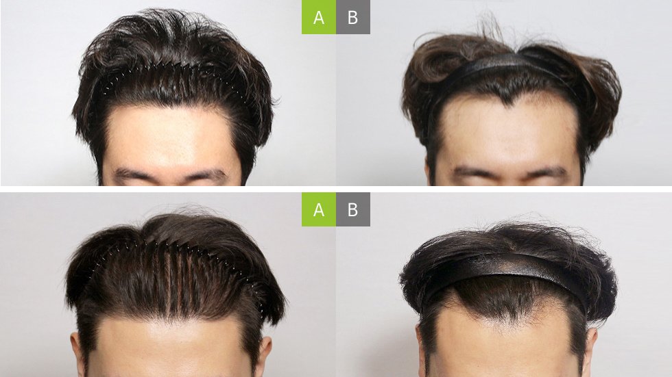 Moaman Hair Transplant Clinic - Moaman Hair Transplant Clinic