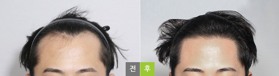 Moaman Hair Transplant Clinic - Moaman Hair Transplant Clinic