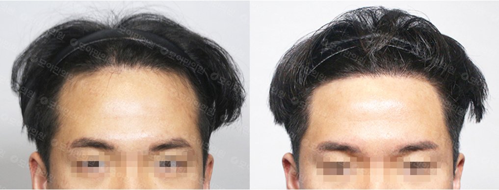 Moaman Hair Transplant Clinic - Moaman Hair Transplant Clinic