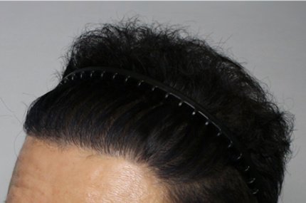 Moaman Hair Transplant Clinic - Moaman Hair Transplant Clinic