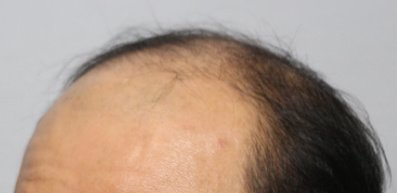 Moaman Hair Transplant Clinic - Moaman Hair Transplant Clinic