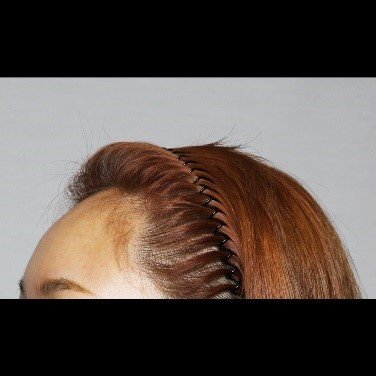 Moaman Hair Transplant Clinic - Moaman Hair Transplant Clinic