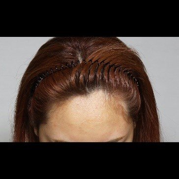 Moaman Hair Transplant Clinic - Moaman Hair Transplant Clinic