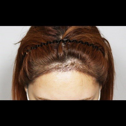 Moaman Hair Transplant Clinic - Moaman Hair Transplant Clinic