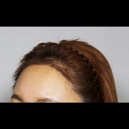 Moaman Hair Transplant Clinic - Moaman Hair Transplant Clinic