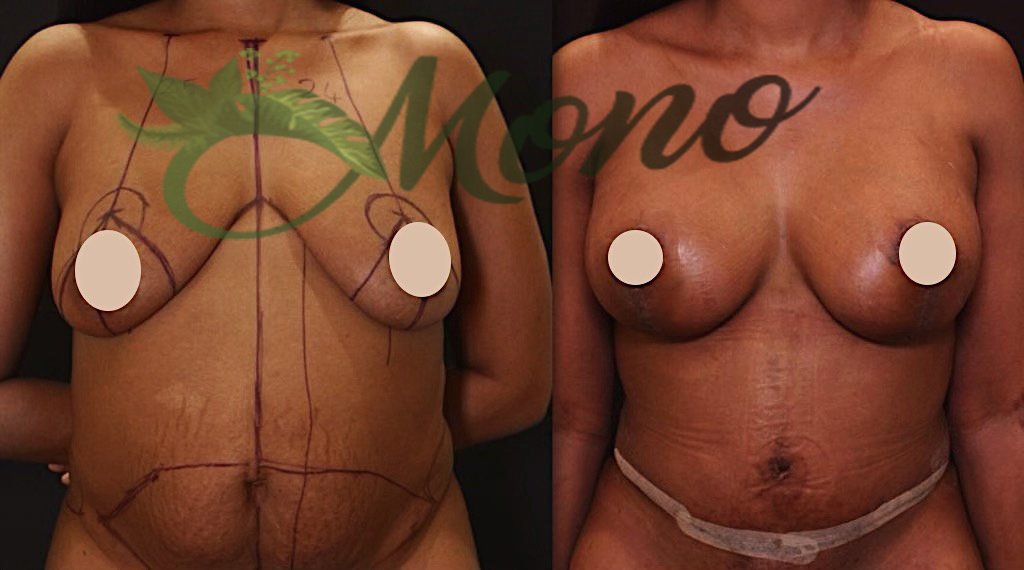 Mono Cosmetic Surgery Center - Mono Cosmetic Surgery Center