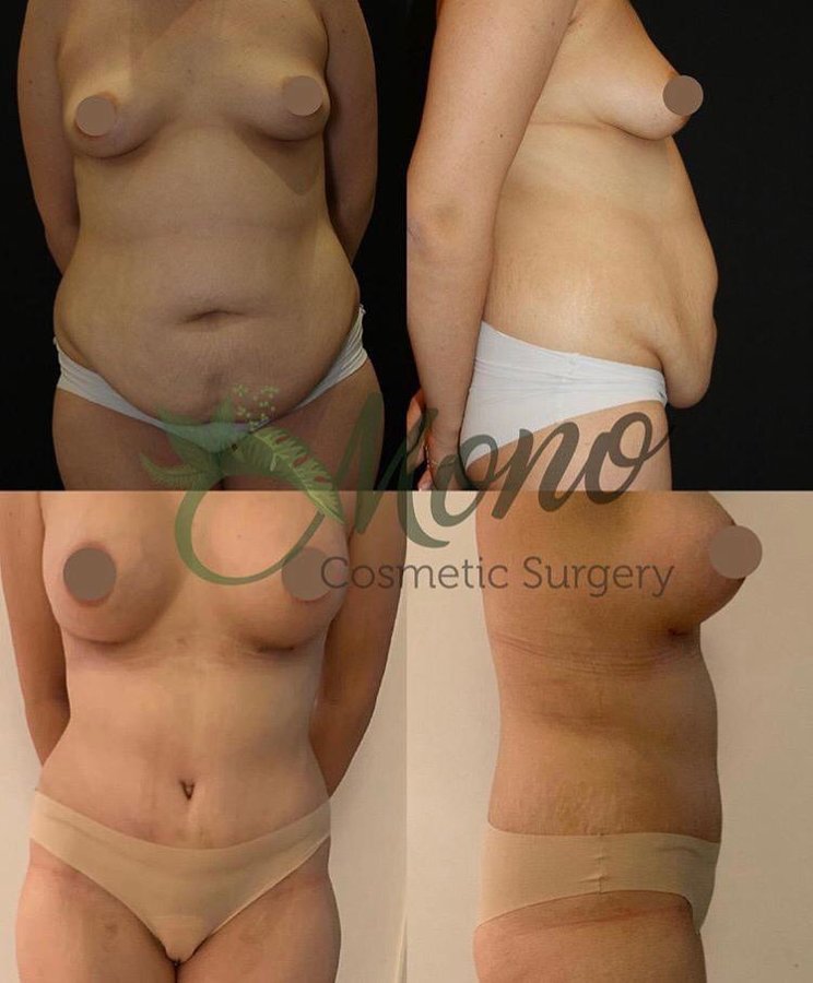 Mono Cosmetic Surgery Center - Mono Cosmetic Surgery Center