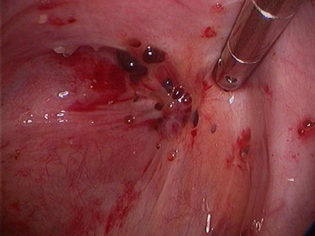 Mr Ioannis Douliotis MBBS MRCOG DFFP - Mr Ioannis Douliotis MBBS MRCOG DFFP