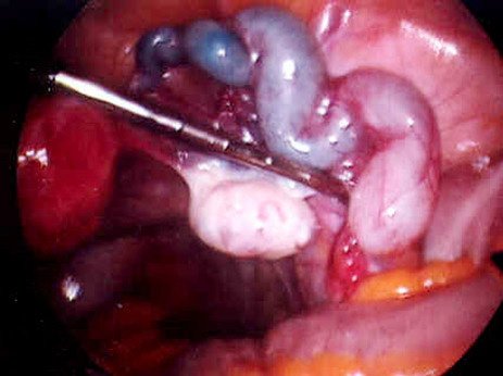 Mr Ioannis Douliotis MBBS MRCOG DFFP - Mr Ioannis Douliotis MBBS MRCOG DFFP