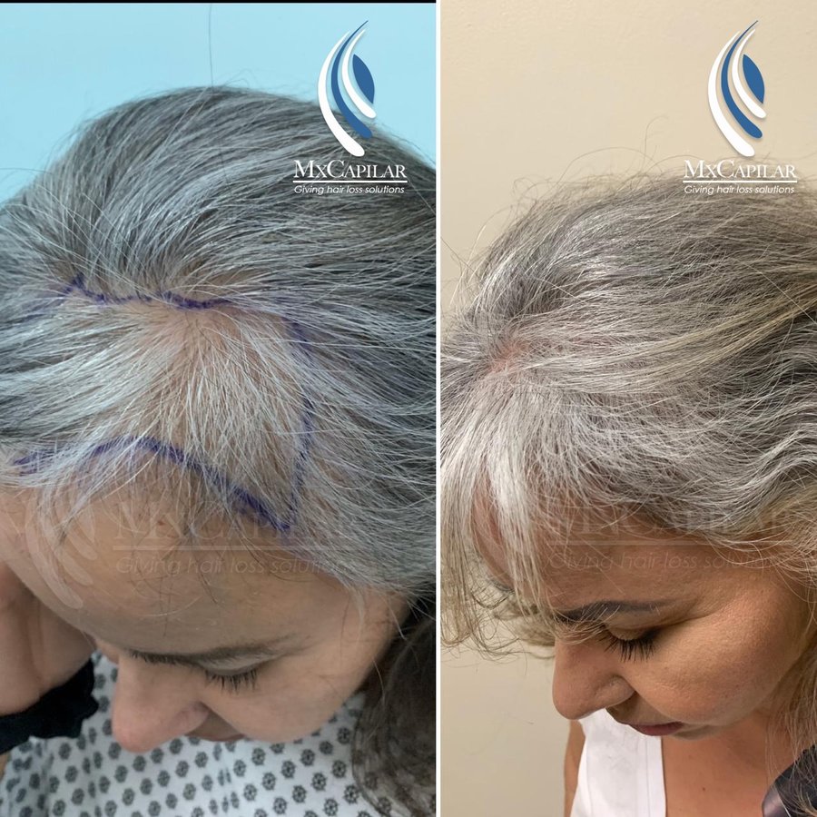 Mxcapilar - Mxcapilar