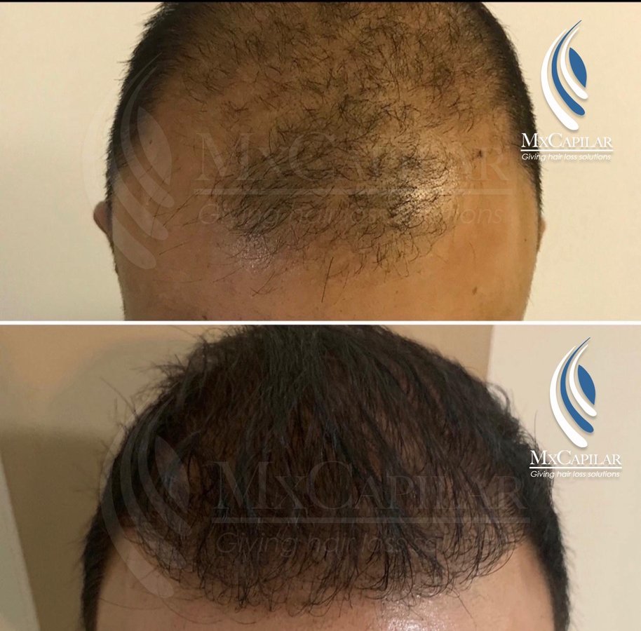 Mxcapilar - Mxcapilar