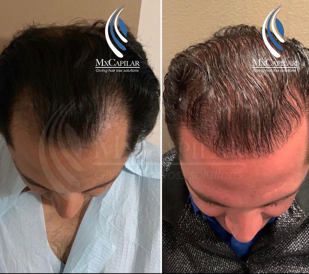 Mxcapilar - Mxcapilar