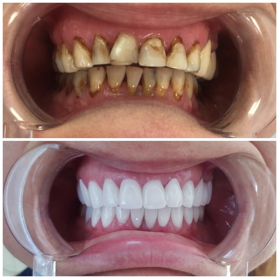 نانو الأسنان - Nano Dental