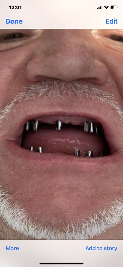 نانو الأسنان - Nano Dental