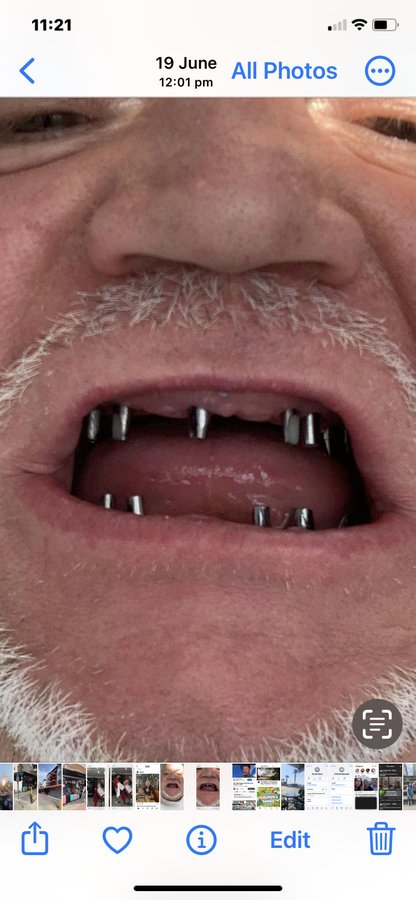 نانو الأسنان - Nano Dental